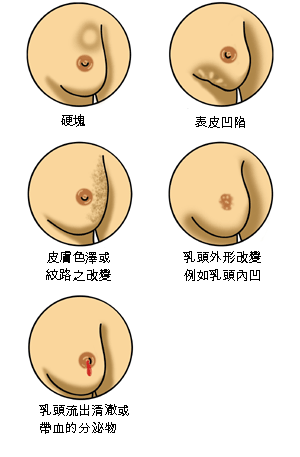 乳腺癌 乳腺癌早期切除后能活几年