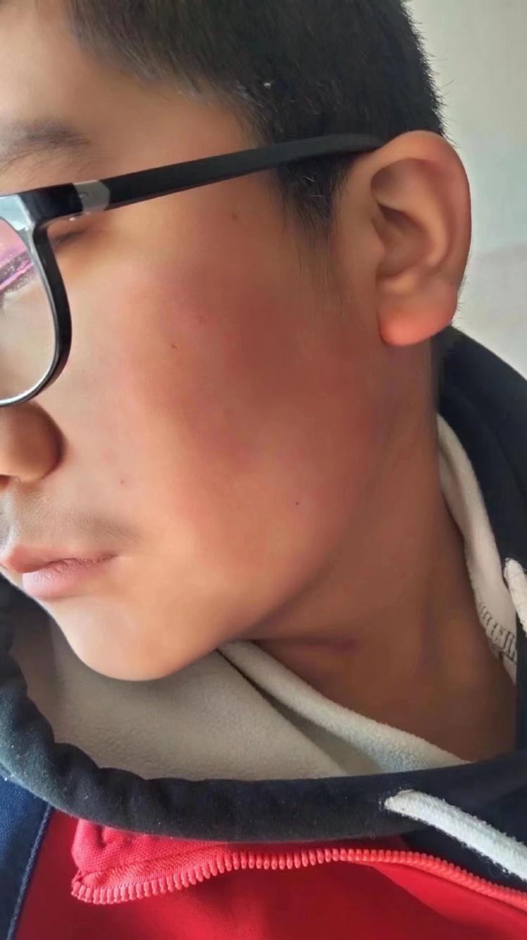 河北一学生被老师扇耳光后失明，家属：快一年了派出所迟迟不立案
